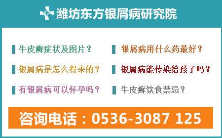 潍坊的医院哪家治疗银屑病专业